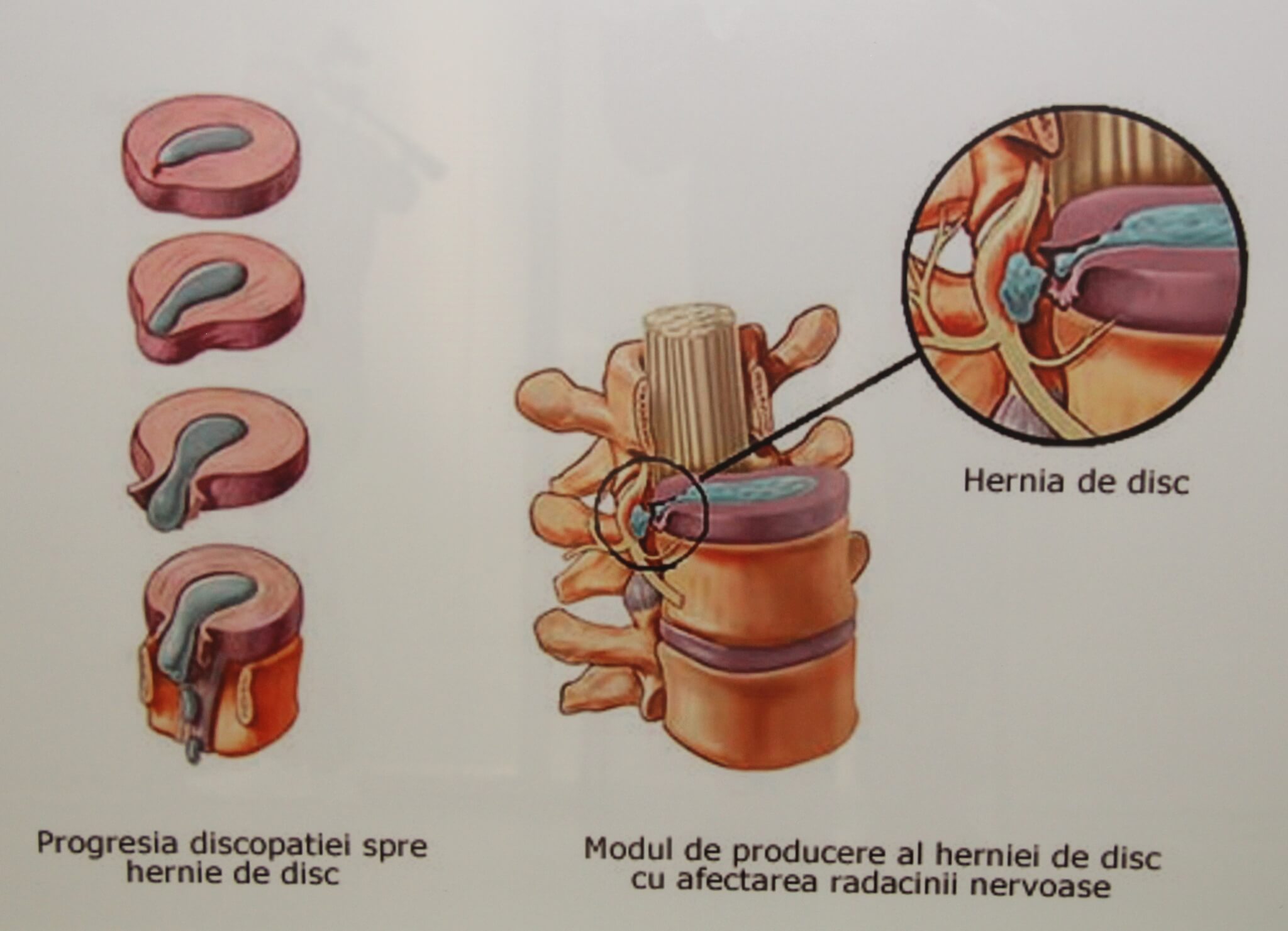 hernia de disc